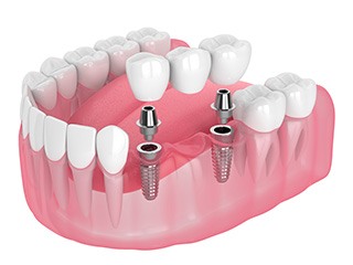 Illustration of an implant bridge