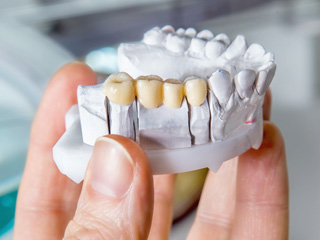 A model of a dental bridge in McComb  