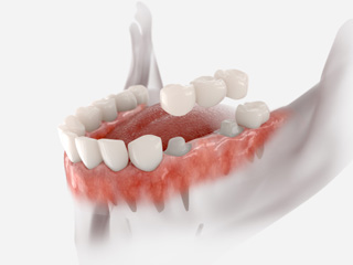 An illustration of a traditional dental bridge anchored by crowns