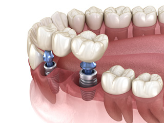 An illustration of an implant bridge secured by dental implants in McComb  