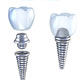 dental implants