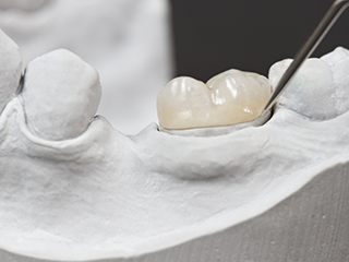 A model of a dental crown being placed over a damaged tooth