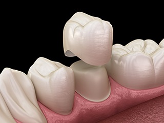 An illustration of a dental crown being placed