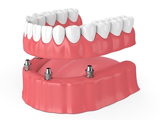 diagram of implant-retained denture on bottom arch 