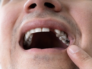 Man showing a missing tooth 