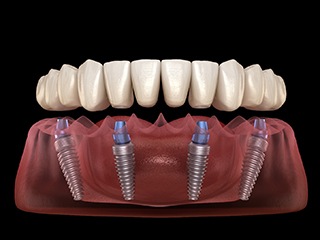 Digital image of an implant denture