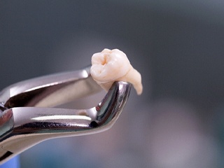 An extracted tooth in McComb