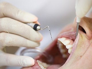 Patient undergoing laser dentistry for gum disease.