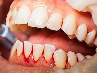 Closeup of bleeding gums due to gum disease