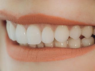 close up perfect smile with veneers
