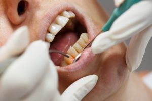 Man undergoing dental laser treatment.