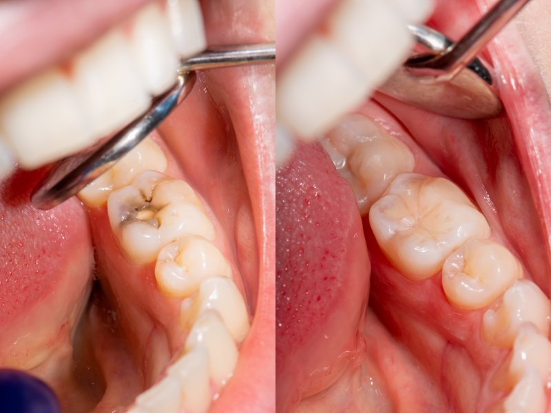 Damaged teeth before and after receiving crowns and fillings