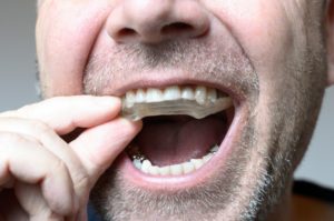 Closeup of man putting in a mouthguard to prevent dental emergency