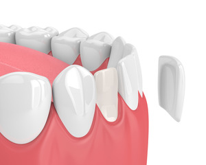 Illustration of a veneer coming off the tooth