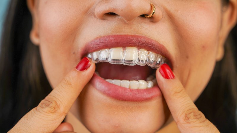 young woman putting on Invisalign tray 